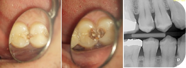 歯の内部への虫歯の進行が顕著な状況