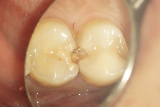 歯の表面から虫歯が透けて見える