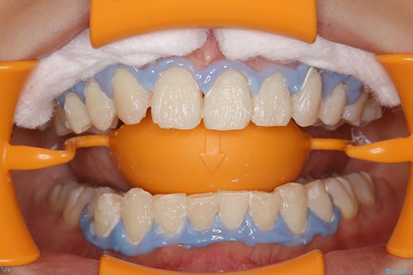 歯ぐきの保護と薬剤の塗布