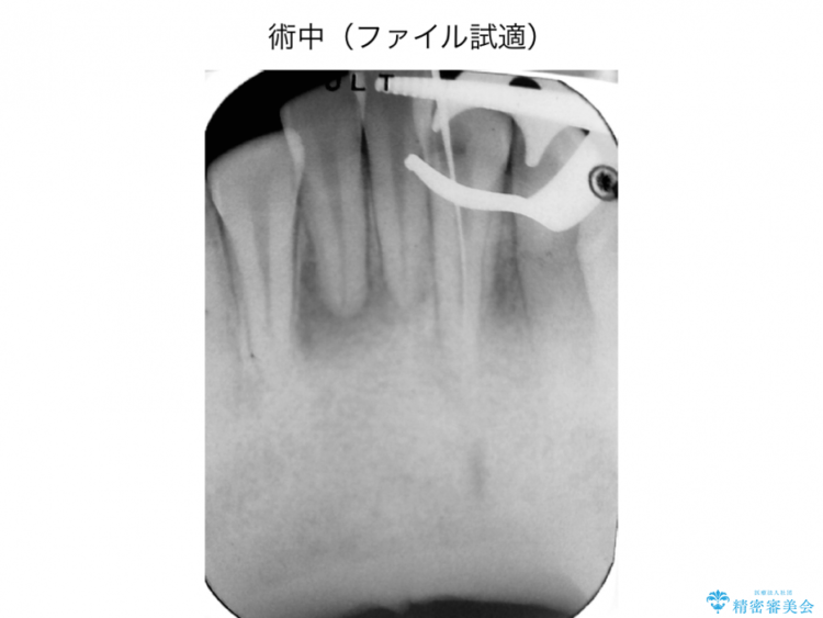 前歯の精密根管治療（イニシャルトリートメント） 治療途中画像