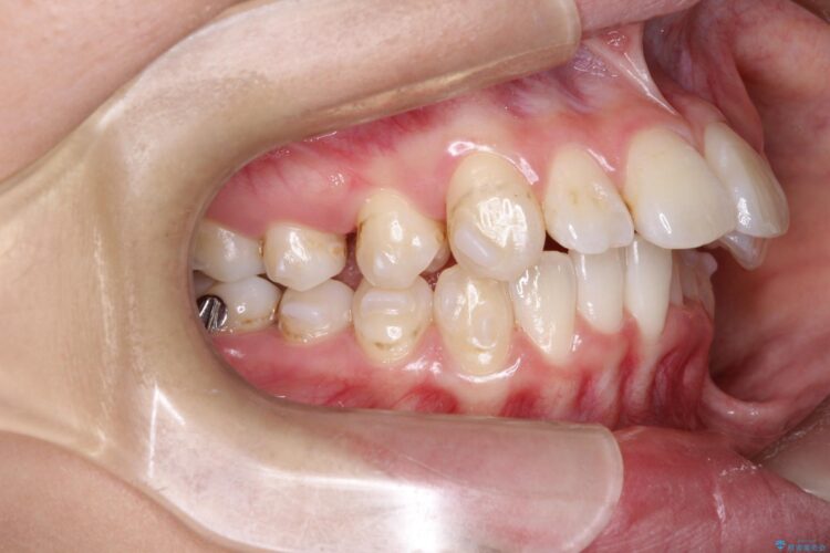 前歯の突出、深い噛み合わせ、ガタつきをマウスピース矯正で 治療途中画像