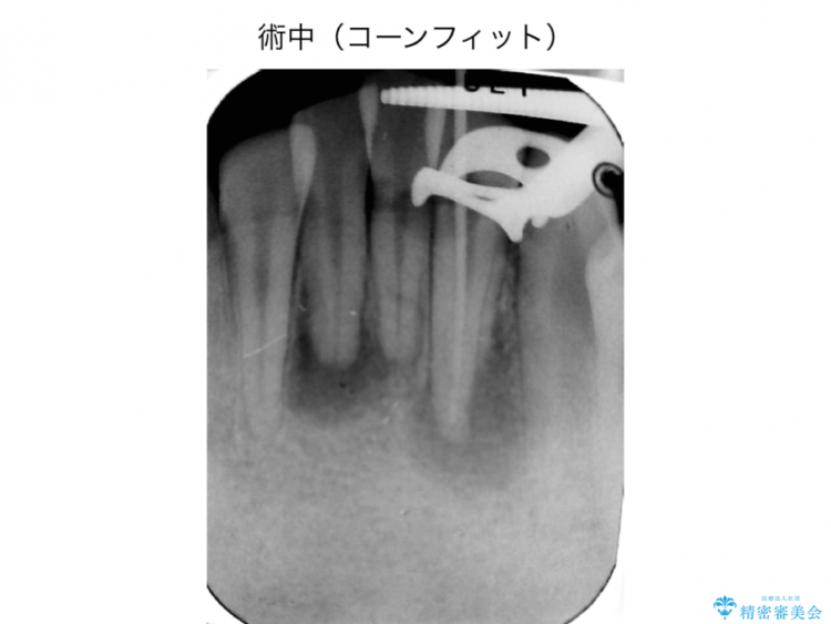 前歯の精密根管治療（イニシャルトリートメント） 治療途中画像