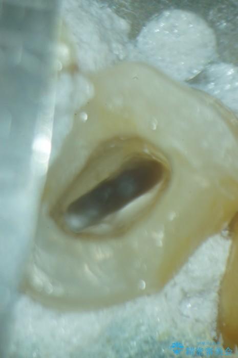 歯ぐきから膿が出てきている左上5番のイニシャルトリートメント 治療途中画像