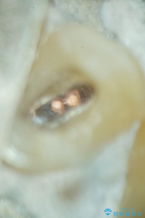 歯ぐきから膿が出てきている左上5番のイニシャルトリートメント 治療途中画像
