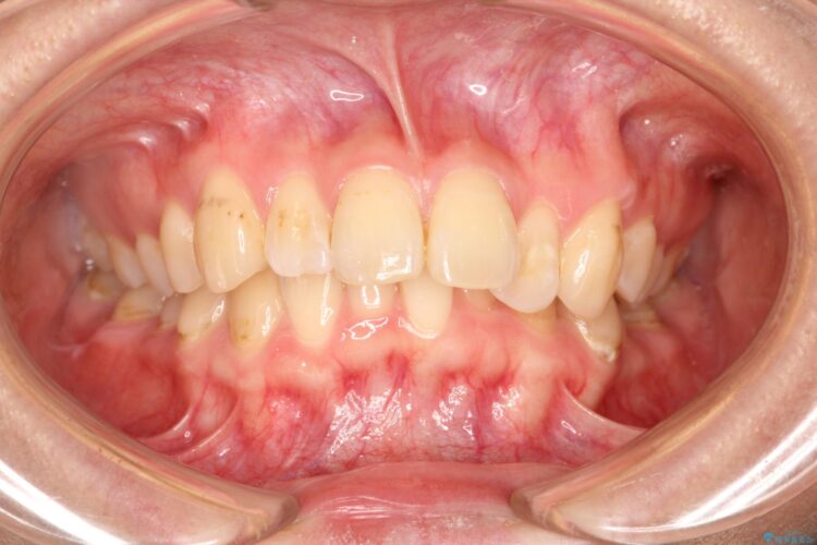 前歯の突出、深い噛み合わせ、ガタつきをマウスピース矯正で ビフォー