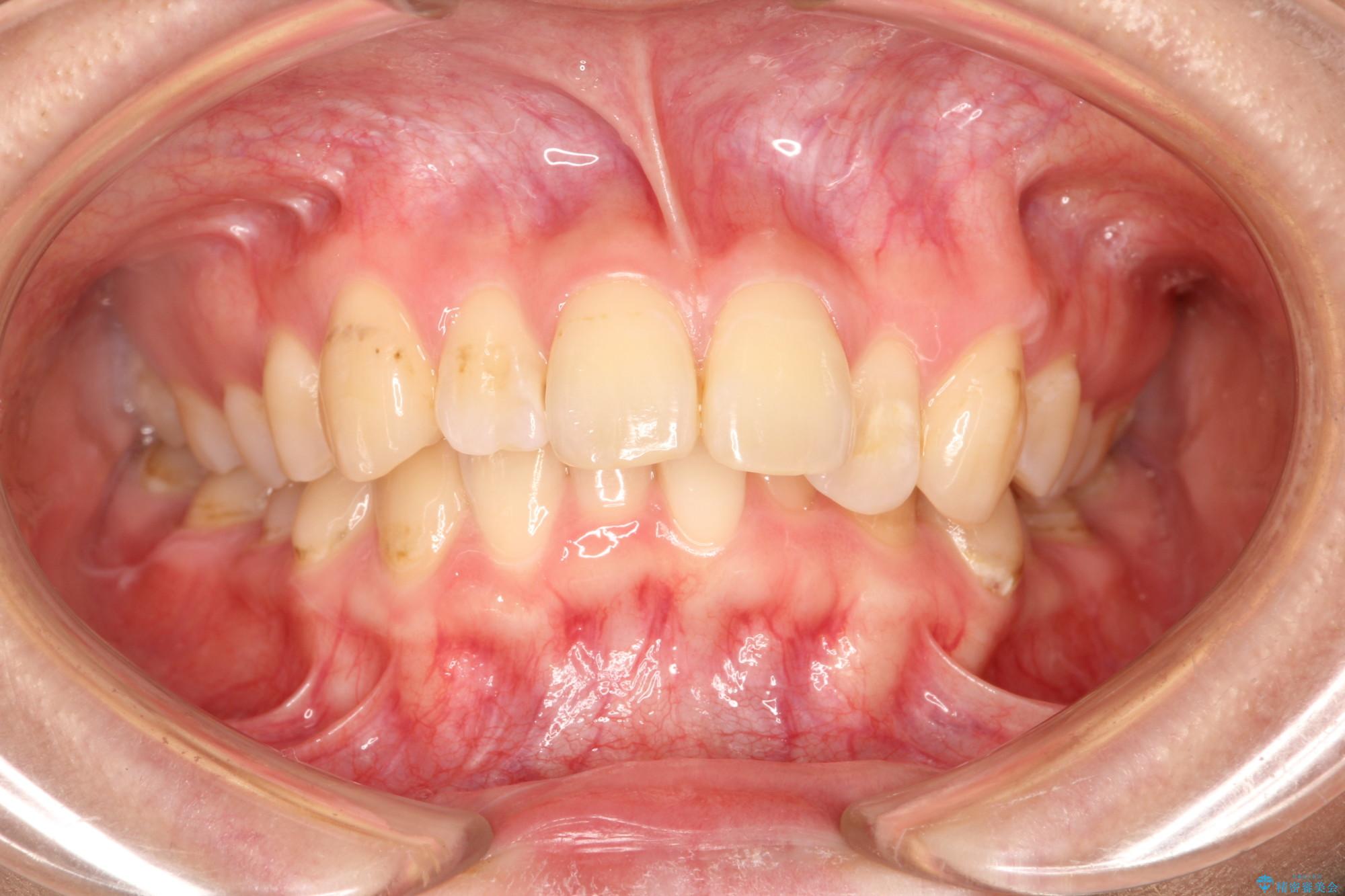 前歯の突出、深い噛み合わせ、ガタつきをマウスピース矯正で 治療前