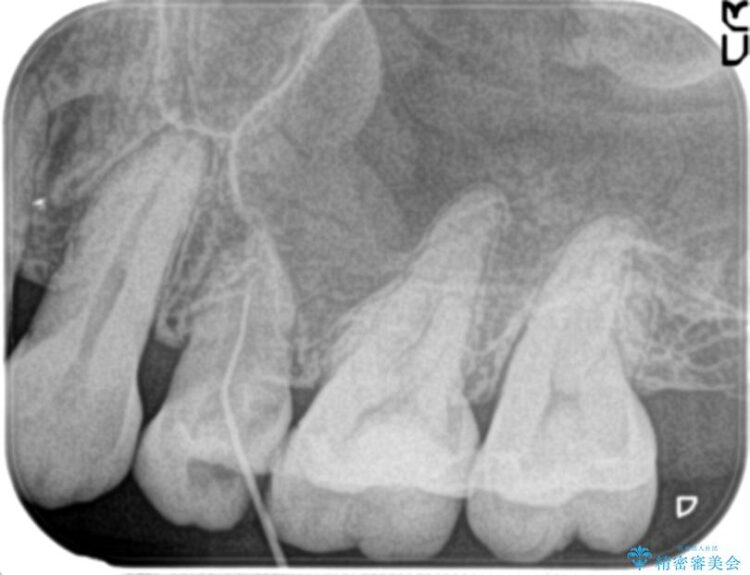 歯ぐきから膿が出てきている左上5番のイニシャルトリートメント ビフォー