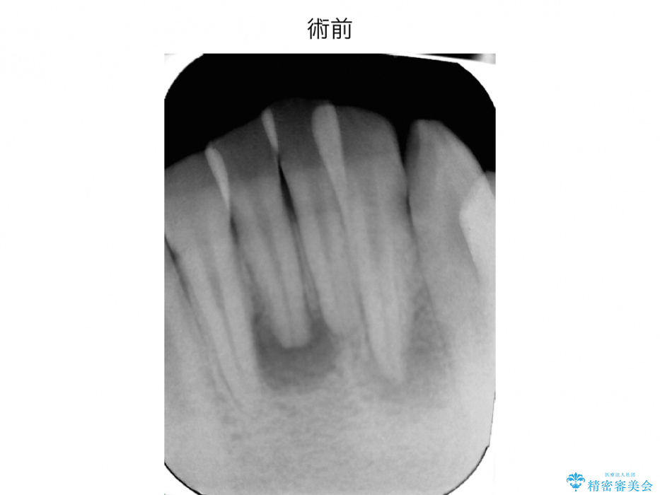 前歯の精密根管治療（イニシャルトリートメント） 治療前