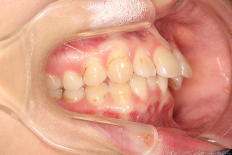 前歯の突出、深い噛み合わせ、ガタつきをマウスピース矯正で 治療前画像