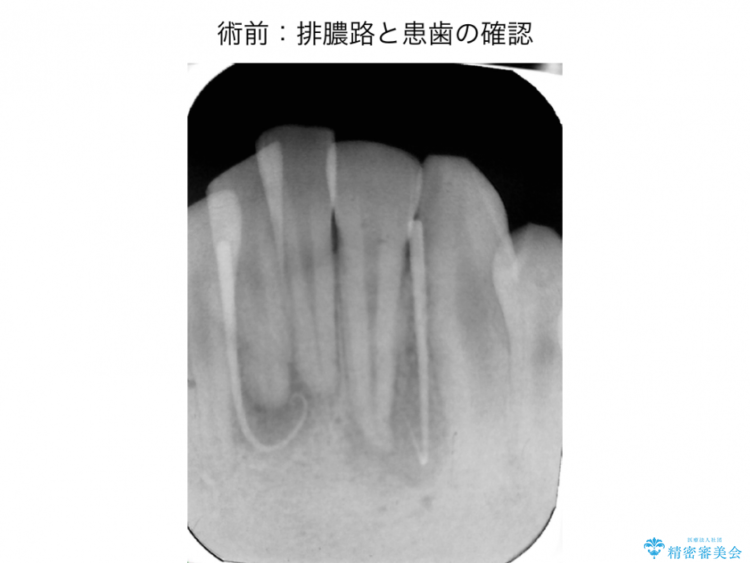 前歯の精密根管治療（イニシャルトリートメント） 治療前画像
