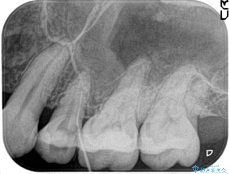 歯ぐきから膿が出てきている左上5番のイニシャルトリートメント 治療前画像