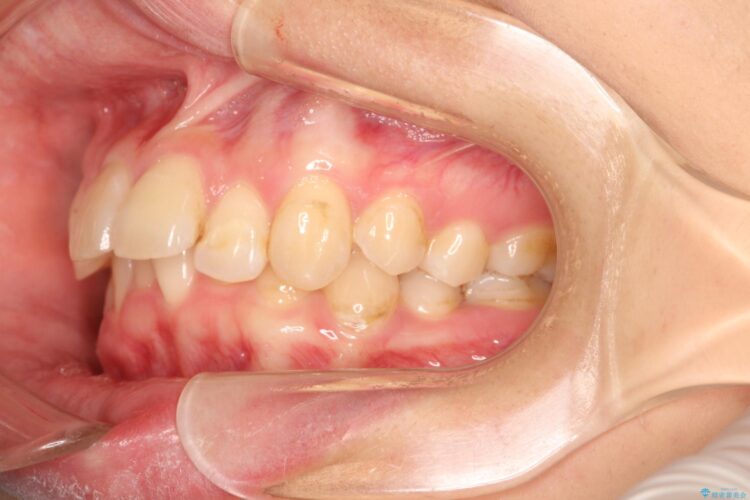 前歯の突出、深い噛み合わせ、ガタつきをマウスピース矯正で 治療前画像