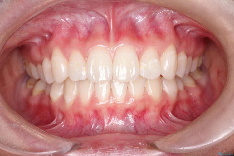 前歯の突出、深い噛み合わせ、ガタつきをマウスピース矯正で アフター