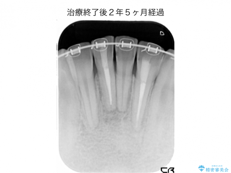 前歯の精密根管治療（イニシャルトリートメント） 治療後画像