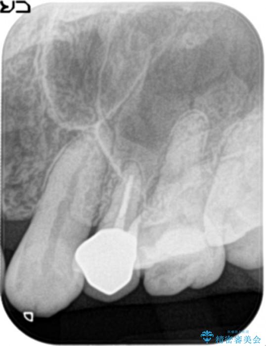 歯ぐきから膿が出てきている左上5番のイニシャルトリートメント アフター