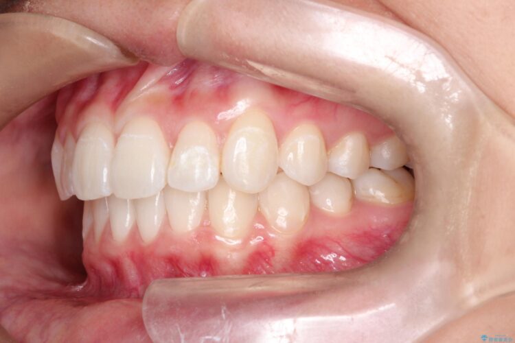 前歯の突出、深い噛み合わせ、ガタつきをマウスピース矯正で 治療後画像
