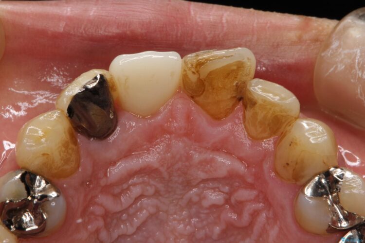 クリーニングによって発見された虫歯 治療前画像