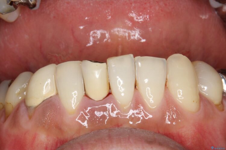 クリーニングによって発見された虫歯 治療後画像
