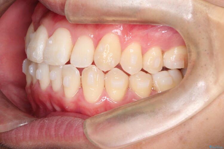 インビザラインで前歯のクロスバイトとガタつきを矯正 治療途中画像