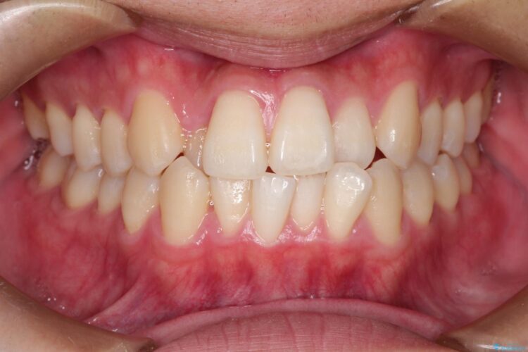 インビザラインで前歯のクロスバイトとガタつきを矯正 治療前画像