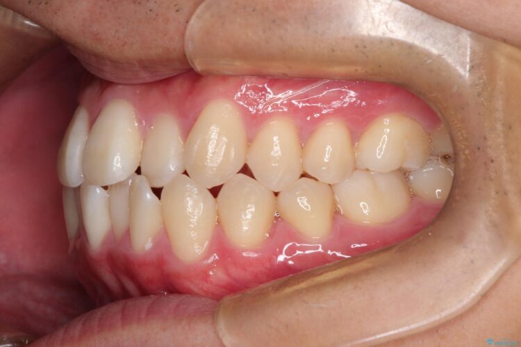 インビザラインで前歯のクロスバイトとガタつきを矯正 治療前画像