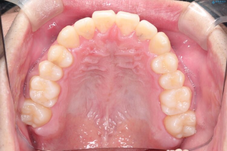 インビザラインで前歯のクロスバイトとガタつきを矯正 治療後画像
