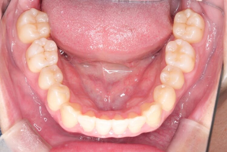 インビザラインで前歯のクロスバイトとガタつきを矯正 治療後画像