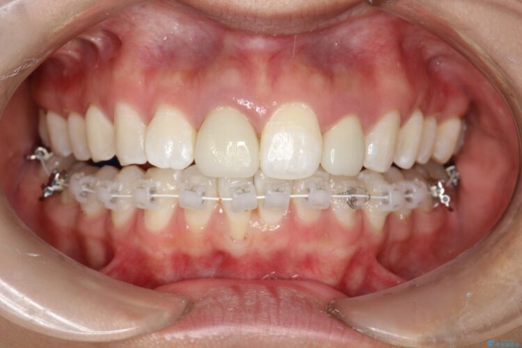 後戻りした歯並びをハーフリンガルで再矯正 治療途中画像