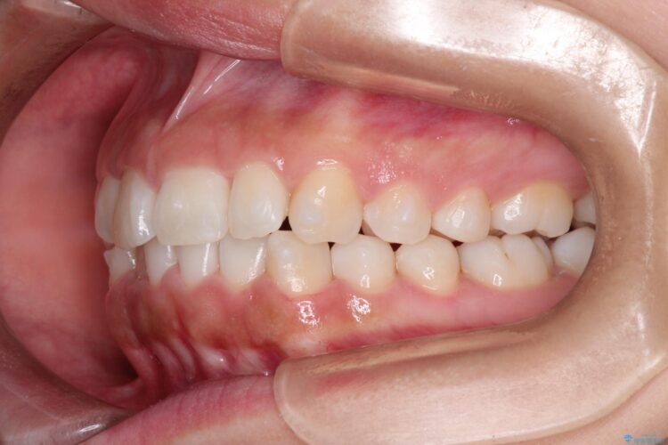 20代女性 インビザラインで叢生(歯並びのガタつき)の治療 治療途中画像
