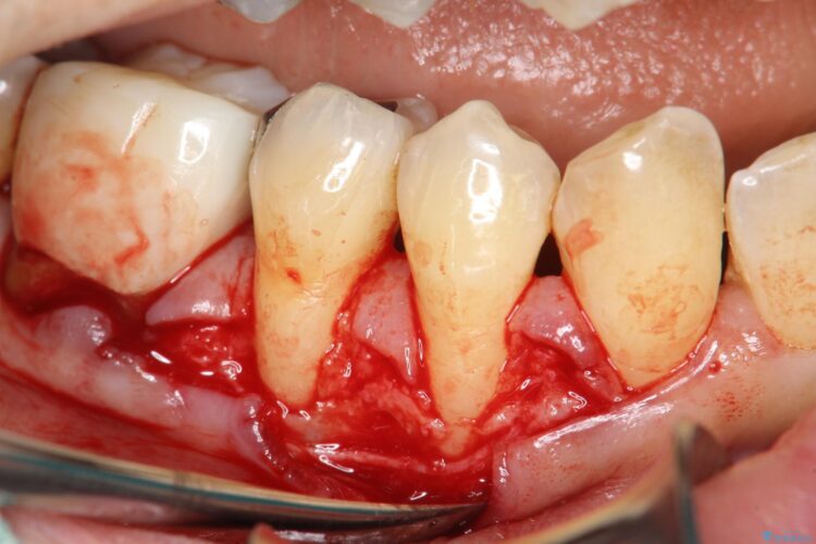 下がってきた歯肉へ再生療法を施術して丈夫な歯肉を獲得 治療途中画像