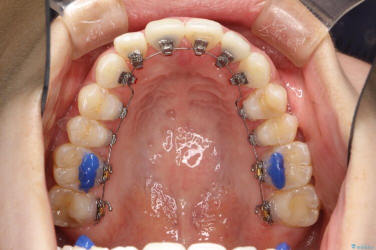後戻りした歯並びをハーフリンガルで再矯正 治療途中画像