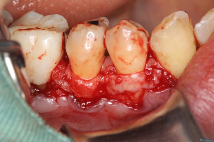 下がってきた歯肉へ再生療法を施術して丈夫な歯肉を獲得 治療途中画像