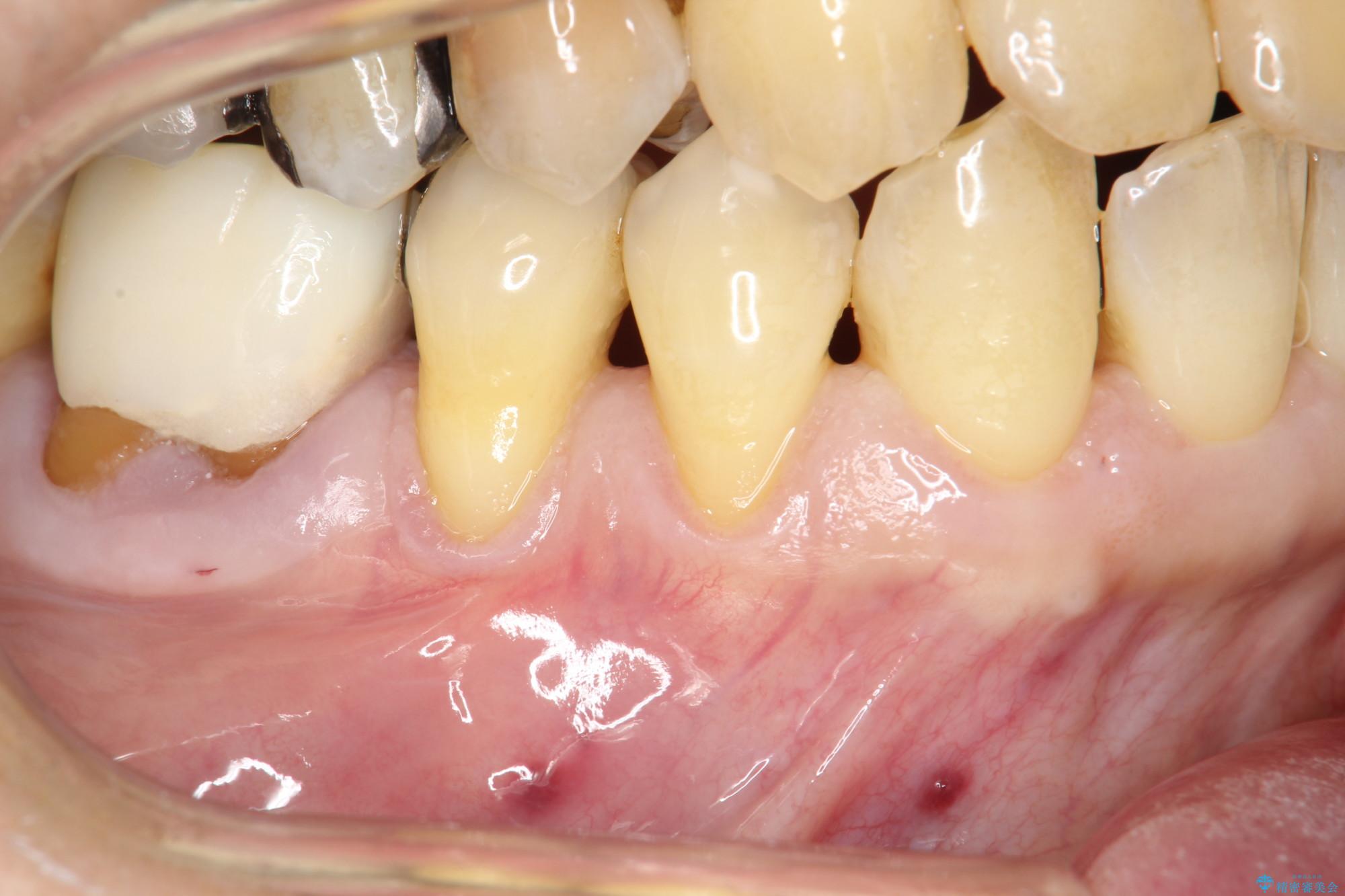下がってきた歯肉へ再生療法を施術して丈夫な歯肉を獲得 治療前