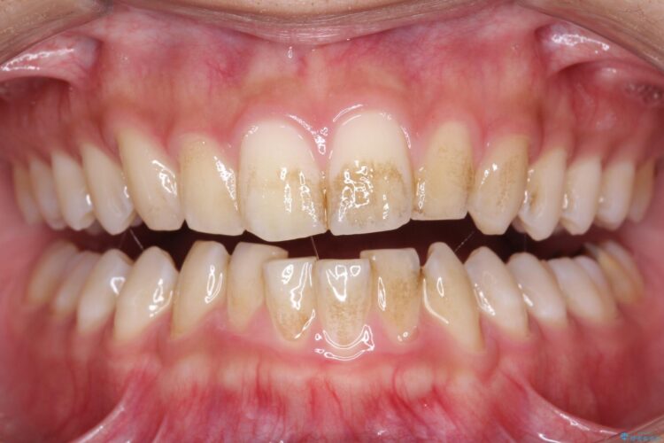 エアフローで茶渋の着色と下の前歯裏側の歯石除去 治療前画像