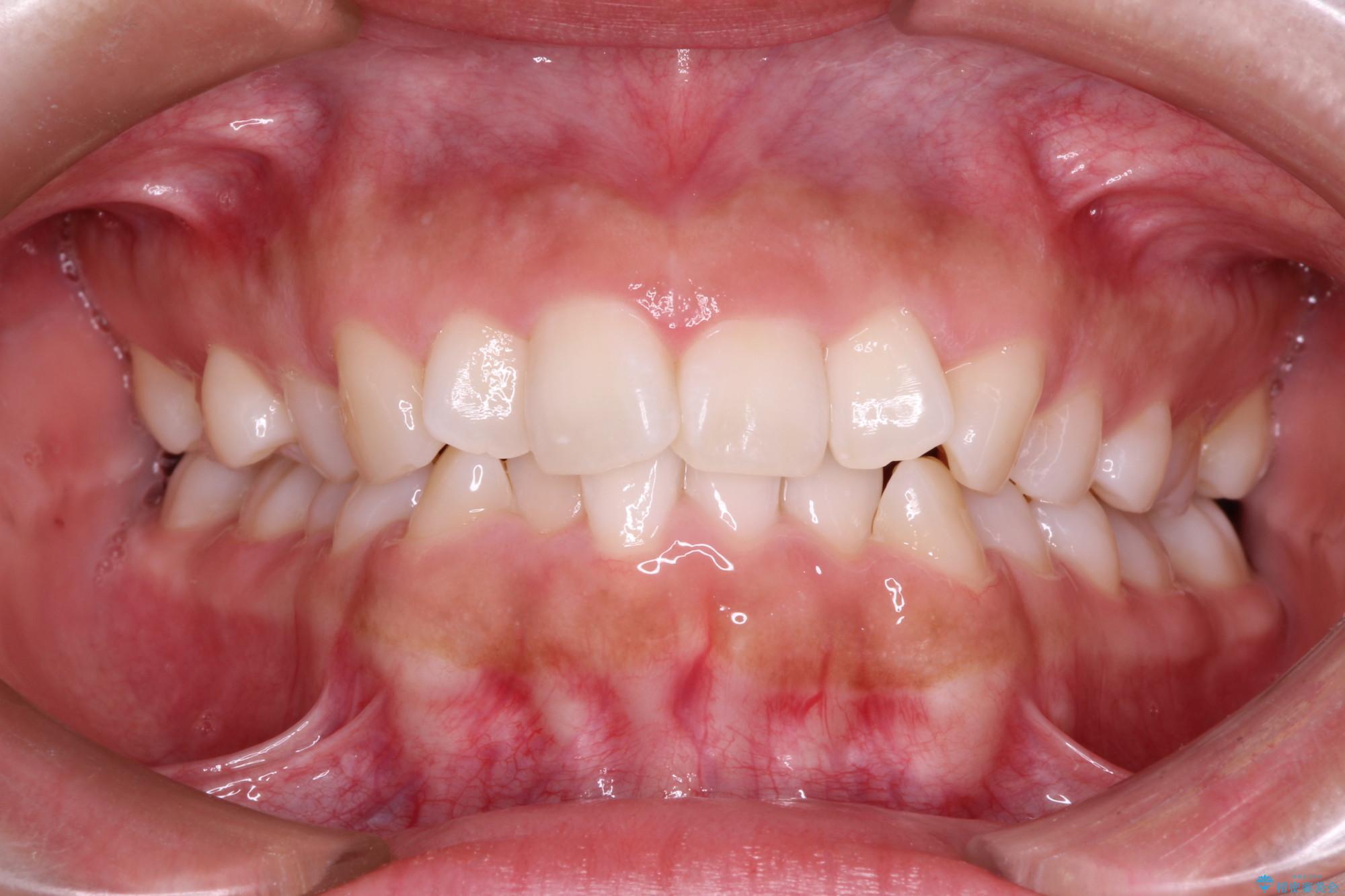 20代女性 インビザラインで叢生(歯並びのガタつき)の治療 治療前