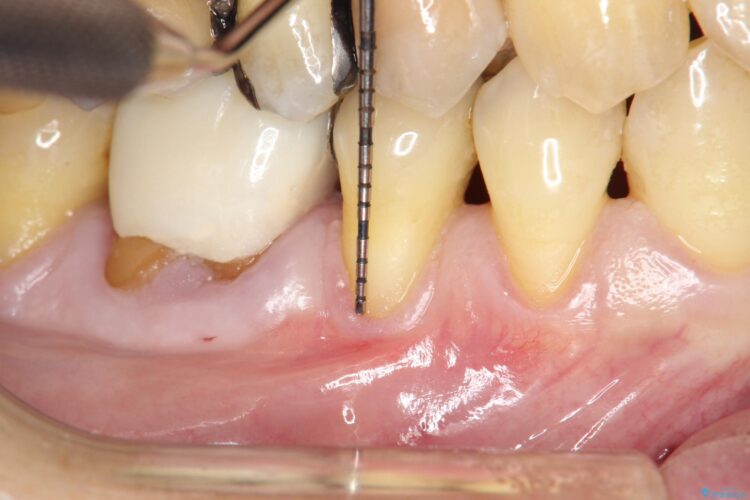 下がってきた歯肉へ再生療法を施術して丈夫な歯肉を獲得 治療前画像