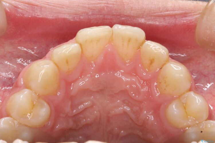 エアフローで茶渋の着色と下の前歯裏側の歯石除去 治療前画像
