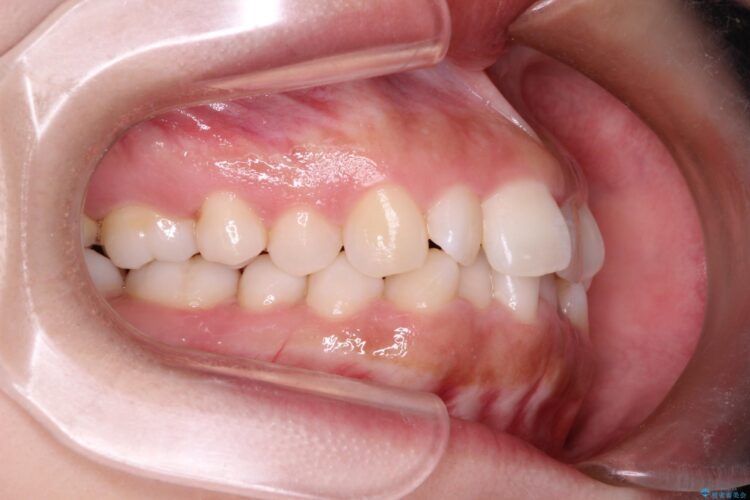 20代女性 インビザラインで叢生(歯並びのガタつき)の治療 治療前画像