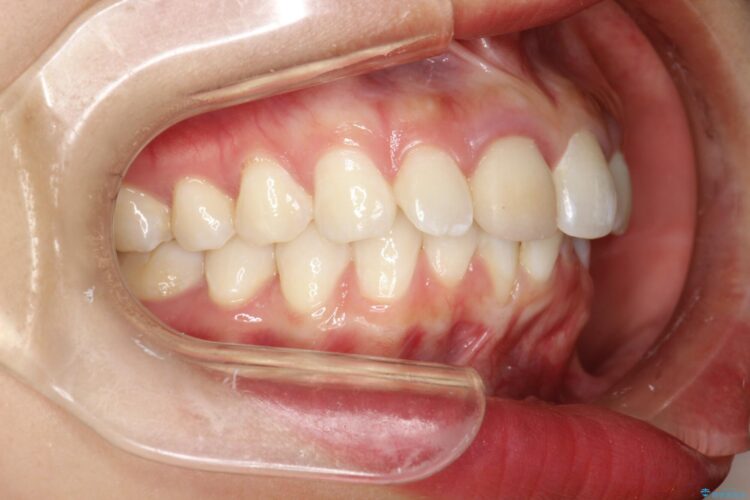 後戻りした歯並びをハーフリンガルで再矯正 治療前画像