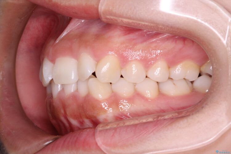 20代女性 インビザラインで叢生(歯並びのガタつき)の治療 治療前画像