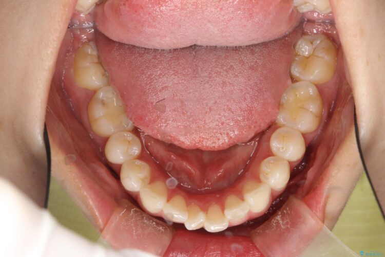 後戻りした歯並びをハーフリンガルで再矯正 治療前画像