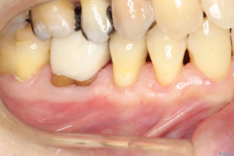 下がってきた歯肉へ再生療法を施術して丈夫な歯肉を獲得 治療後画像