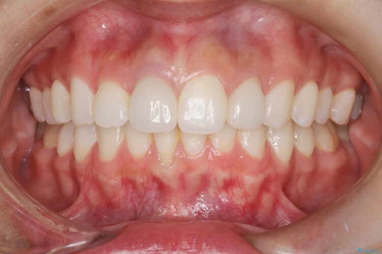 後戻りした歯並びをハーフリンガルで再矯正 治療後画像