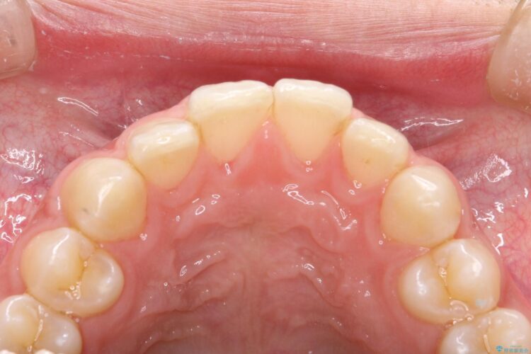 エアフローで茶渋の着色と下の前歯裏側の歯石除去 治療後画像