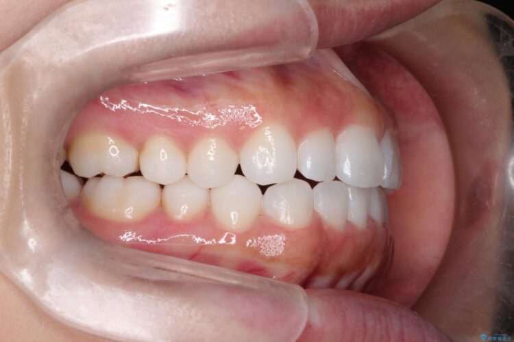 20代女性 インビザラインで叢生(歯並びのガタつき)の治療 治療後画像