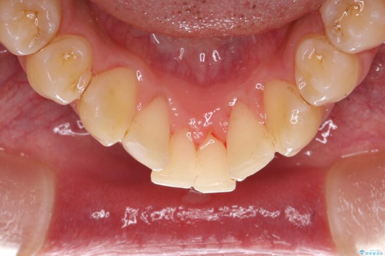 エアフローで茶渋の着色と下の前歯裏側の歯石除去 治療後画像