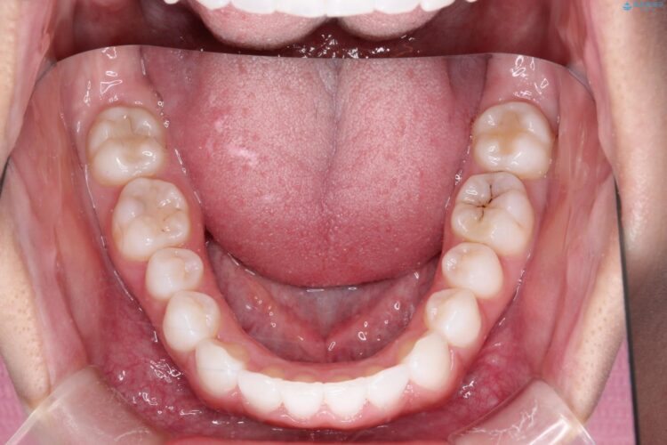 20代女性 インビザラインで叢生(歯並びのガタつき)の治療 治療後画像