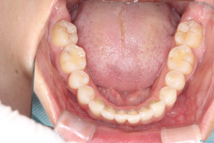 後戻りした歯並びをハーフリンガルで再矯正 治療後画像