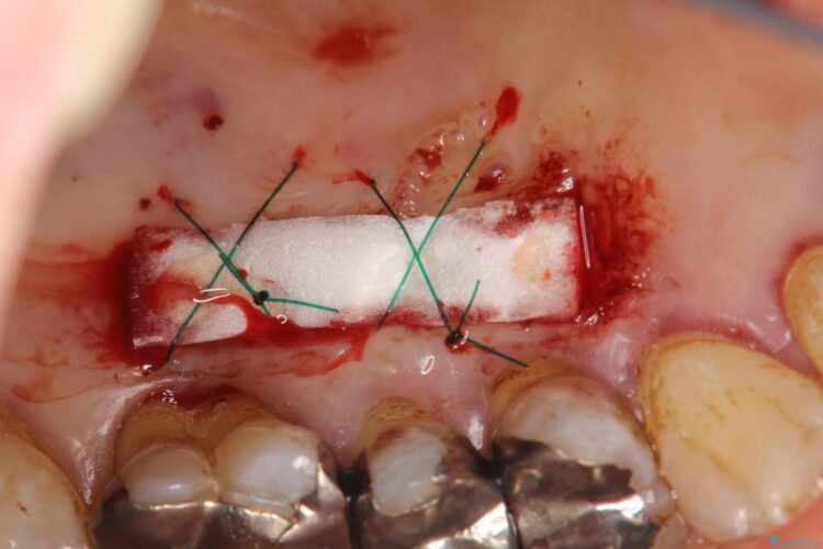 下がってきた歯肉へ再生療法を施術して丈夫な歯肉を獲得 治療後画像