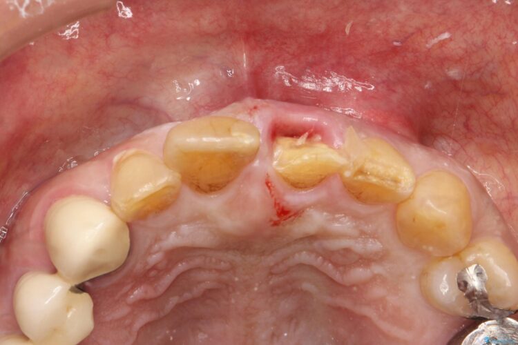 折れた前歯を抜歯せずに残す治療 治療途中画像